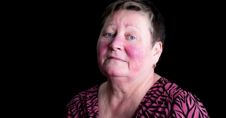 Lupus Rash Understanding And Coping With Lupus Skin Rashes