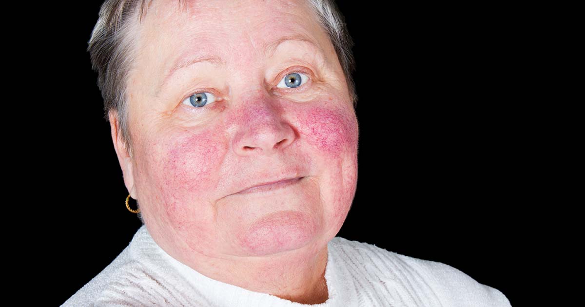 Woman has lupus butterfly rash on face
