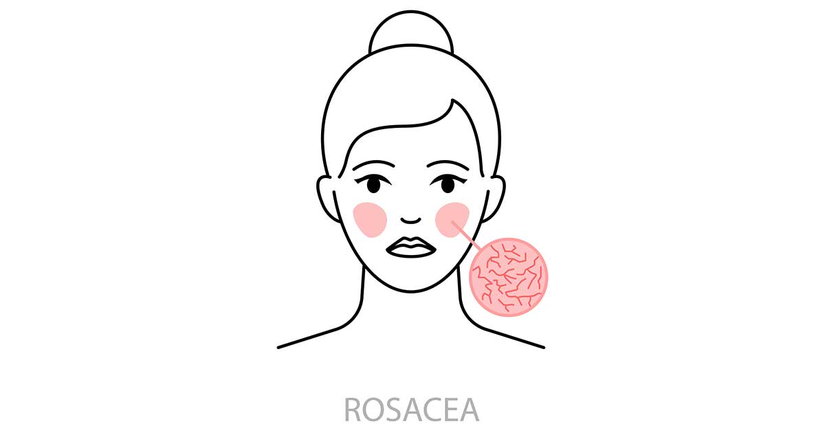 an icon showing what a rosacea rash looks like